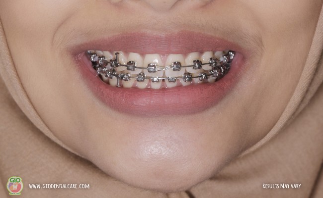 gio-self-ligating-braces